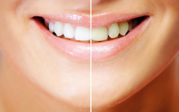 teeth whitening in Miami