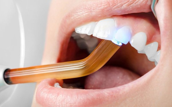 Composite and Tooth Color Fillings, Cosmetic tooth fillings