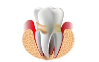 periodontal disease treatment in Miami